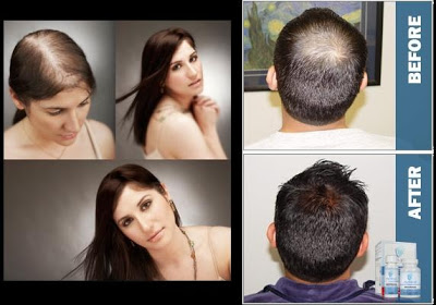 top hair loss treatments