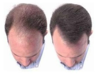 Best Hair Loss Remedies