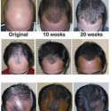 Natural Hair Loss Treatments