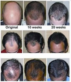 natural hair loss remedies